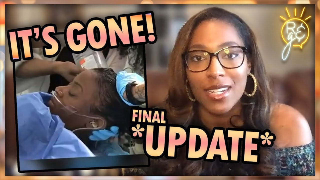 Gorilla Glue Girl’s Hair Update #2 – The Glue is Gone! Removed via Surgery | Rise & Grind